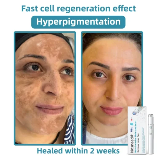 Remifa® Non-invasive Mole & Wart Removal Laser Pen