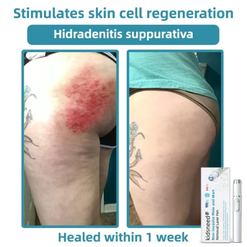 Remifa® Non-invasive Mole & Wart Removal Laser Pen
