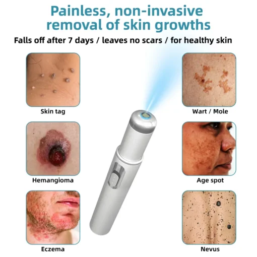 Remifa® Non-invasive Mole & Wart Removal Laser Pen